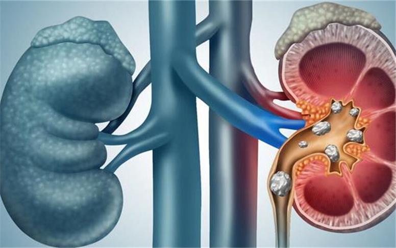 سنگ کلیه: پیشگیری، تشخیص و درمان