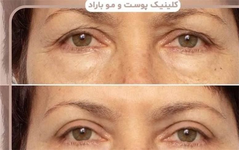 راهنمای کامل مراحل بلفاروپلاستی ، از مشاوره تا دوران نقاهت