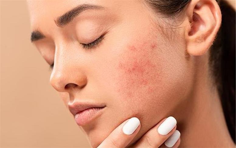 پاکسازی پوست چرب و جوش دار در منزل