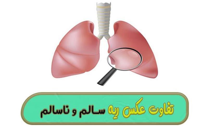 تفاوت عکس ریه سالم و ناسالم؛ آنچه تصاویر رادیولوژی به ما می‌گویند