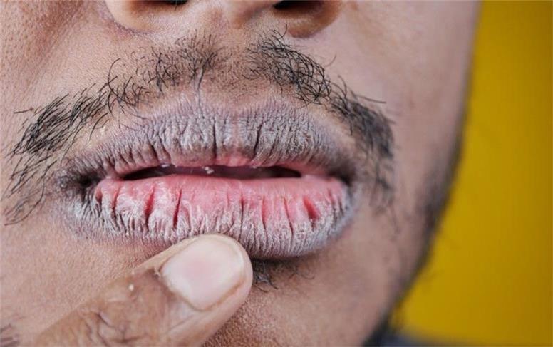 علت سیاهی لب در افراد مختلف چیست؟