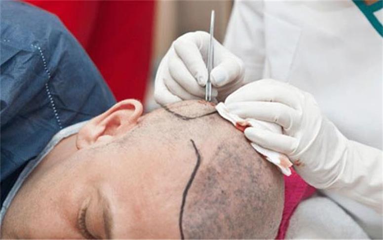 بهترین کلینیک کاشت مو در تهران کدام است؟ ملاک‌های انتخاب