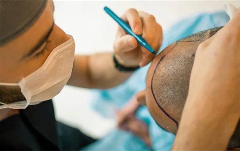 آموزش اصولی کاشت مو در آموزشگاه ایرانیان ملل