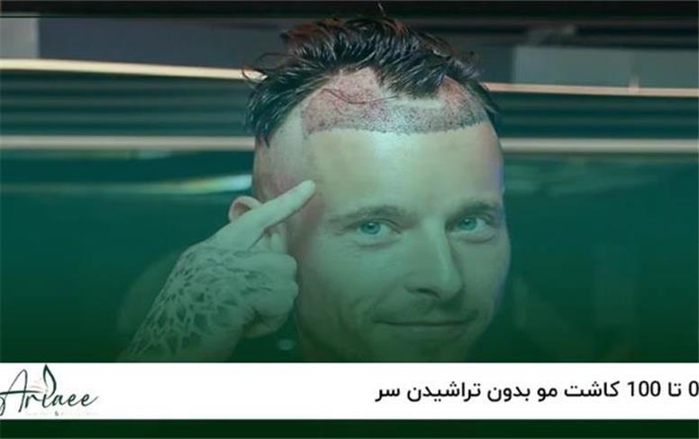 کاشت موی بدون تراشیدن (No Shave FUE) چیست و مناسب چه کسانی است؟