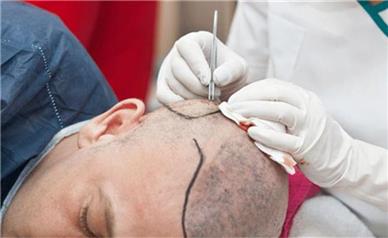 بهترین کلینیک کاشت مو در تهران کدام است؟ ملاک‌های انتخاب