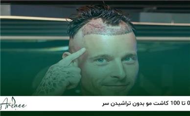 کاشت موی بدون تراشیدن (No Shave FUE) چیست و مناسب چه کسانی است؟