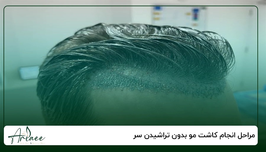 مراحل انجام کاشت مو بدون تراشیدن سر 