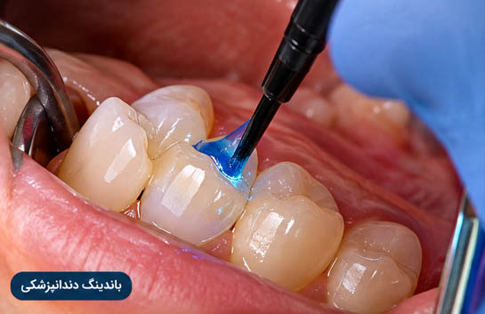 استفاده از باندینگ دندانپزشکی برای ترمیم دندان